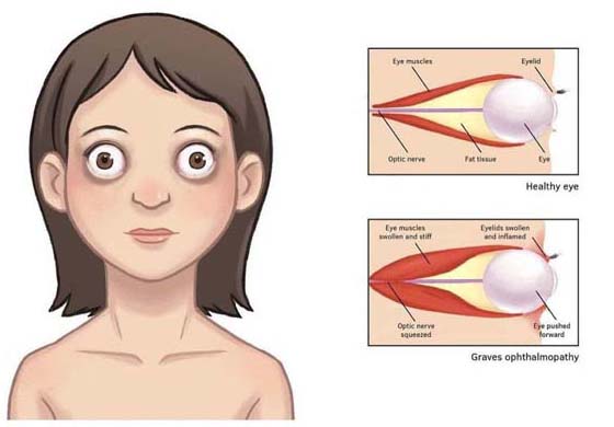 Bulging of the eyes | Thyroid Eye Disease Treatment Trials