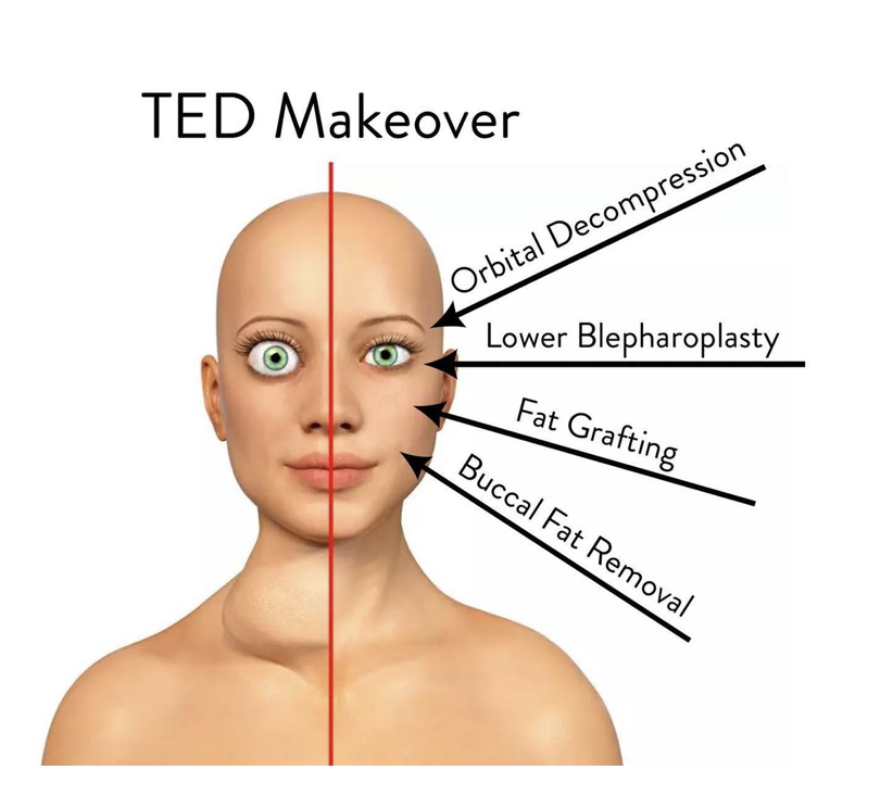 TED Makeover | Bulging Eyes Thyroid Disease | TED Clinical Studies