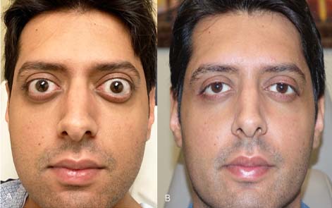 Thyroid Eye Disease Surgery | Before and After TED Surgery Man